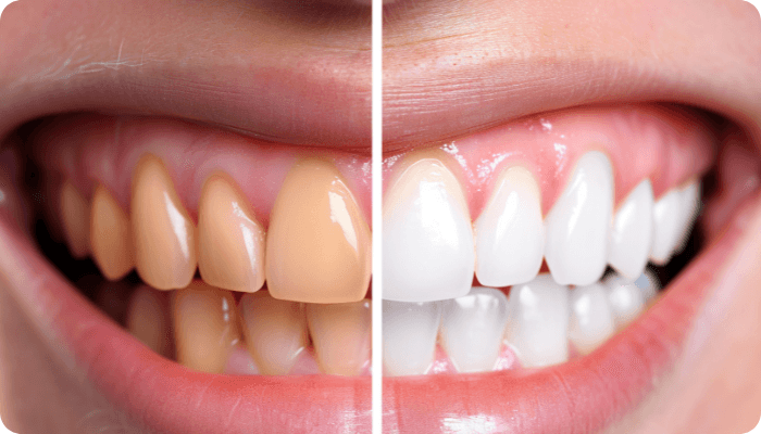 Clareamento dental