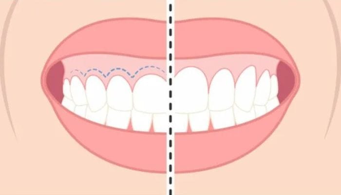 ilustração genvivoplastia