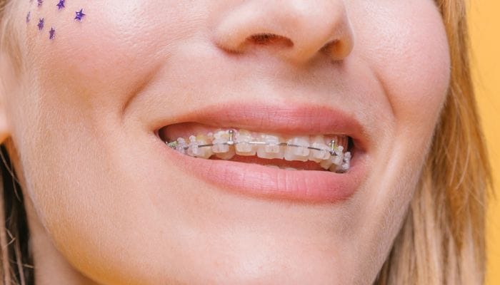 Aparelho autoligado estetico