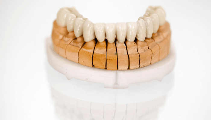 Coroa de porcelana metal free