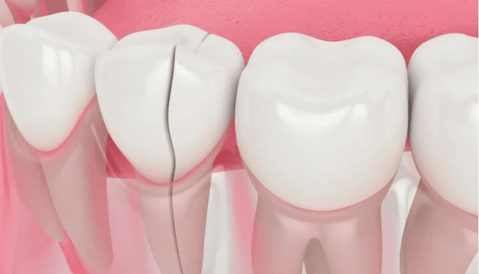 Dente quebrado: quando é necessário colocar uma coroa dentária?