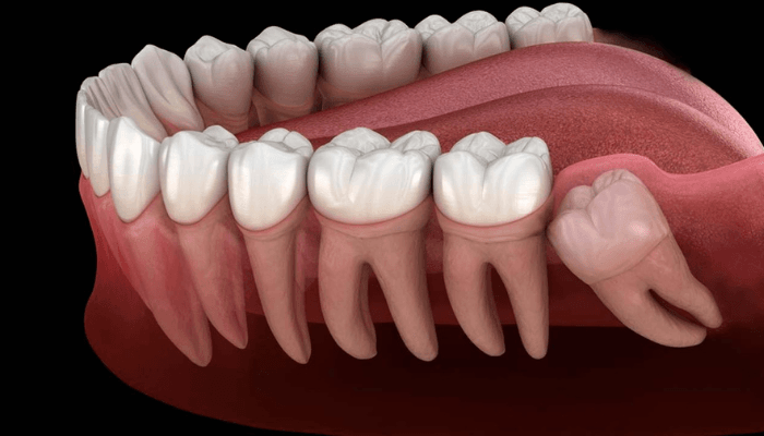 Quando o siso precisa ser extraído