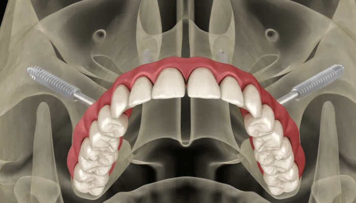Implante Zigomático: o Que É e Como Pode Transformar Seu Sorriso Definitivamente
