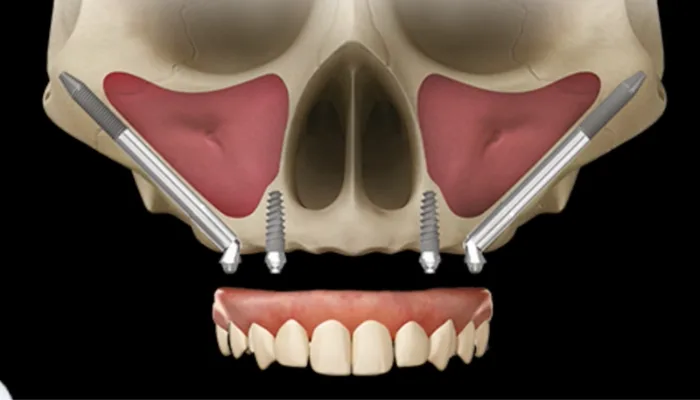 Prótese protocolo com implante zigomático