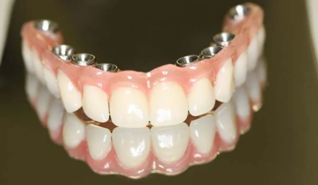 Dentadura x Prótese Protocolo: Qual a Melhor Opção?