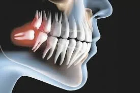 Dor de Dente: O Que Causa, Como Tratar e Quando Buscar Ajuda?