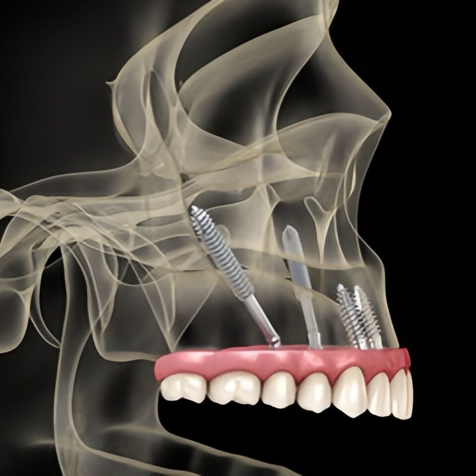 Dentista na Vila Matilde: Implantes Zigomáticos para Quem Tem Pouco Osso