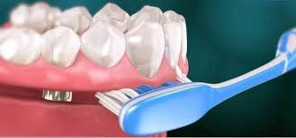 Limpeza de Protocolo: Guia Completo Para Garantir a Saúde do Seu Implante Fixo