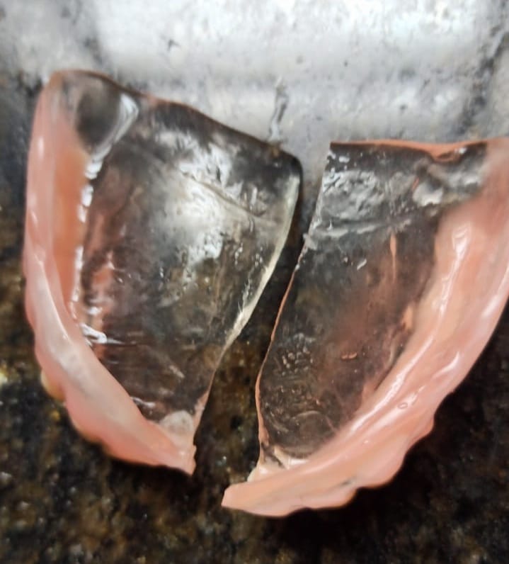 Conserto de Prótese Dentária: o que é, como funciona e quando fazer