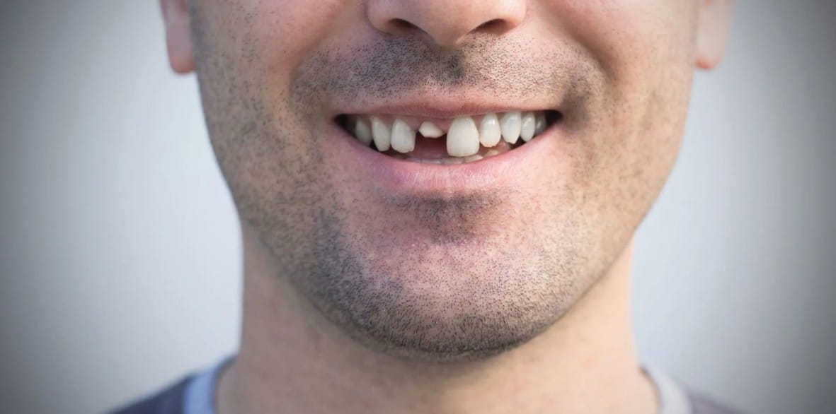 Como funciona a prótese fixa de 1 dente? Veja como recuperar a estética e a mastigação com conforto. OdontoGama Vila Matilde é referência!