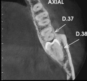 Dente incluso é perigoso? Descubra agora os riscos que você não pode ignorar