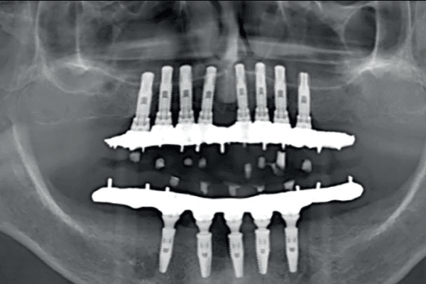10 Benefícios da Prótese Protocolo que Transformam a Autoestima