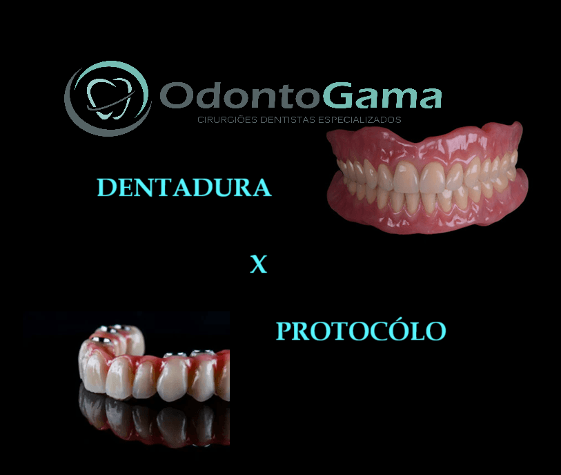  Prótese Protocolo ou Dentadura? Diferenças e Vantagens que Você Precisa Conhecer
