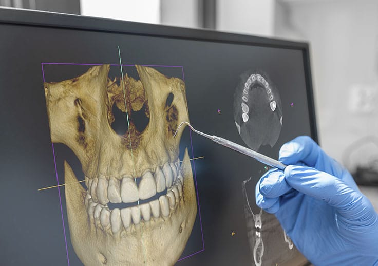 Mitos e Verdades sobre Prótese Protocolo: O que a Odontologia Diz