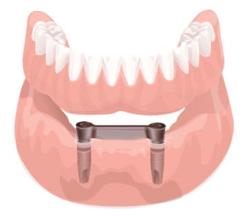 Overdenture barra clip: a solução moderna para reabilitar o sorriso com segurança