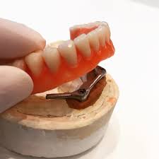 Overdenture barra clipe: quem pode fazer e como é o passo a passo do tratamento