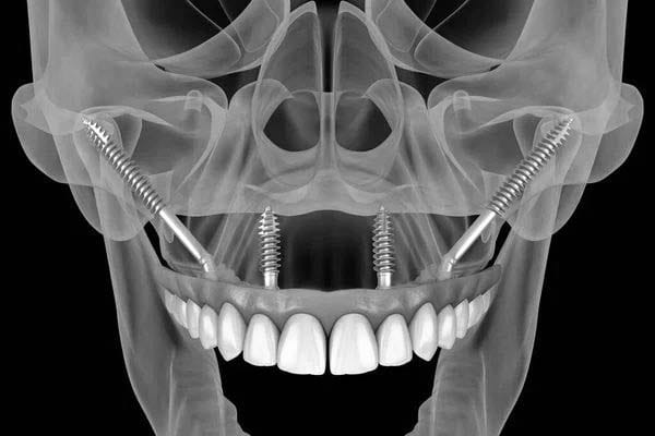 odonto gama Implante Zigomático: solução definitiva para quem perdeu muito osso