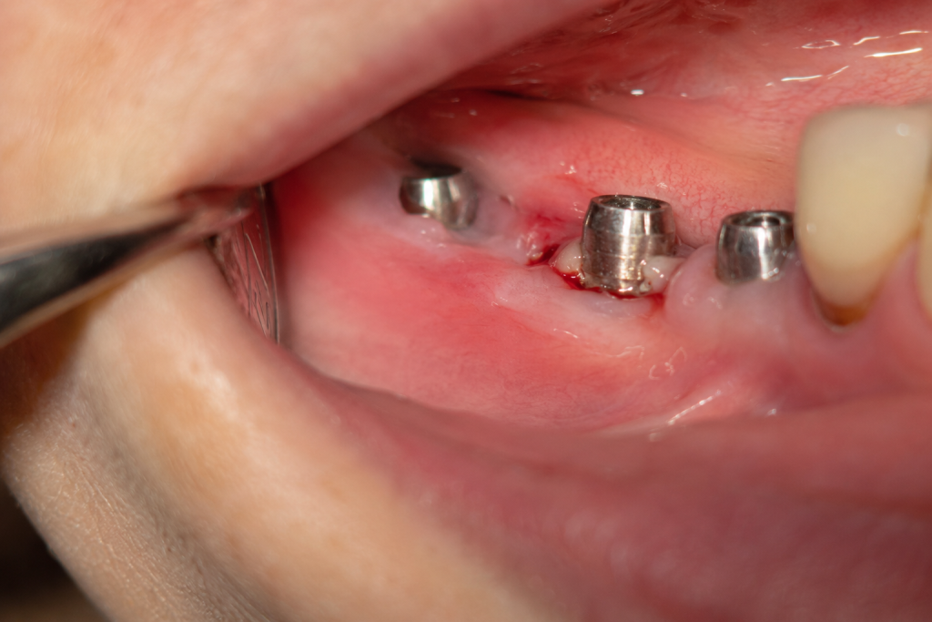 Periimplantite