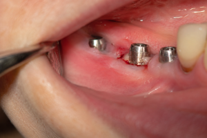 Periimplantite