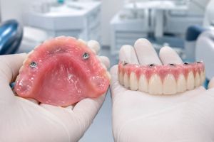 Protocolo ou overdenture