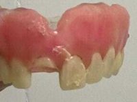 conserto de prótese odonto gama