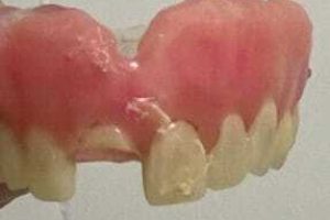 conserto de prótese odonto gama