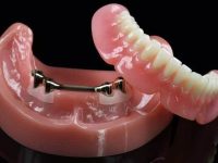 Guia completo sobre overdenture barra clipe: o que é, benefícios e indicações