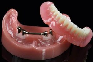 Guia completo sobre overdenture barra clipe: o que é, benefícios e indicações