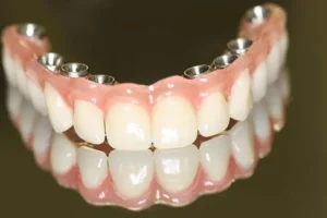 Dentadura x Prótese Protocolo: Qual a Melhor Opção?